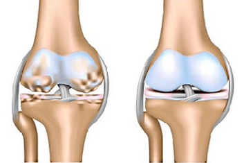 Articulation saine et arthrose