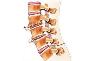 spondylartrose comme causes de maux de dos