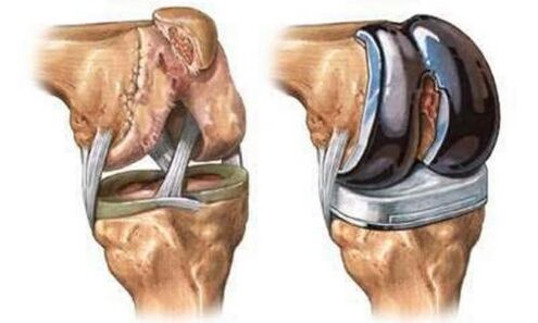 Endoprothétique de l'articulation du genou pour l'arthrose