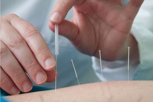 L'acupuncture est une méthode de traitement des douleurs dans le bas du dos causées par l'ostéochondrose.