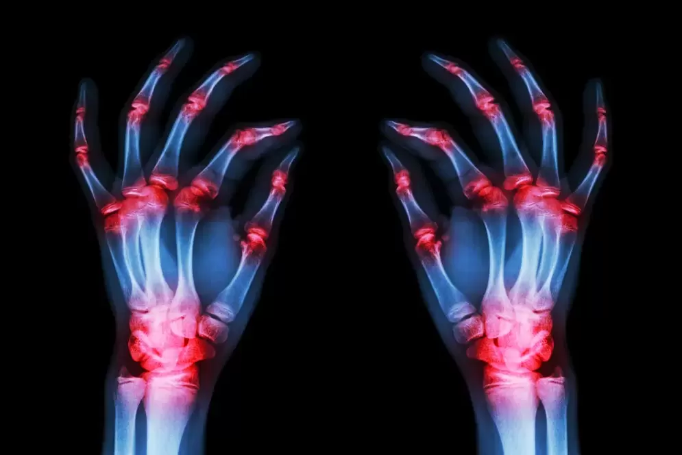 arthrose des articulations des doigts