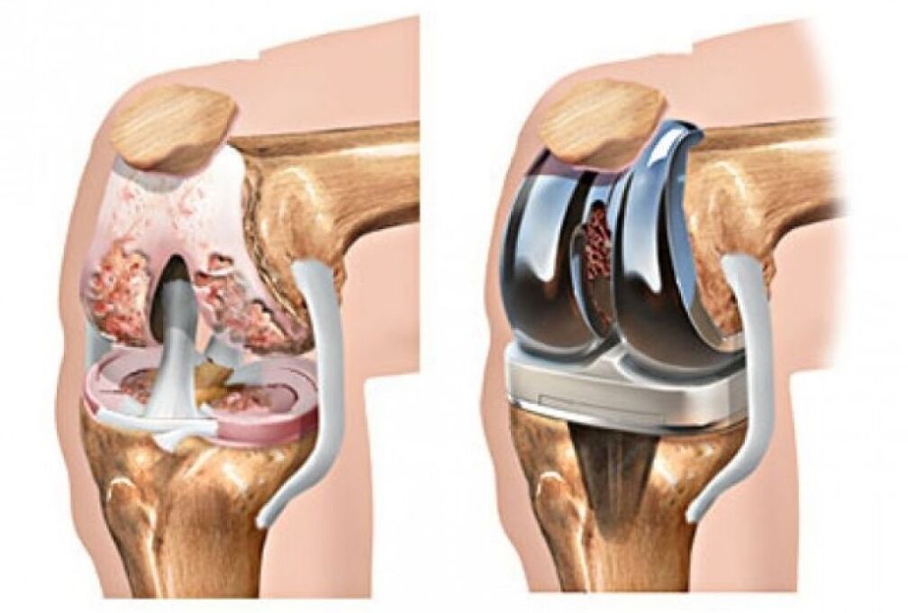 prothèse de genou pour arthrose