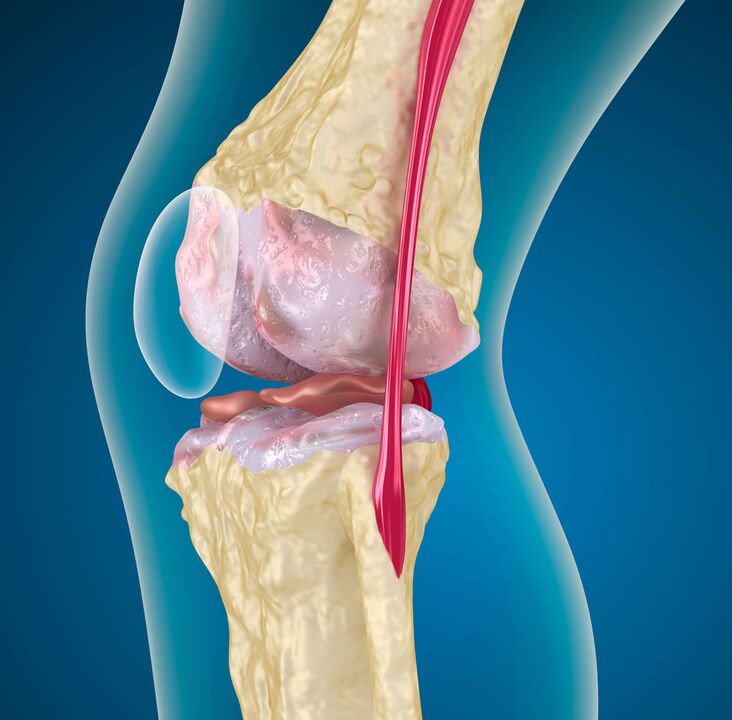 Arthrose de l'articulation du genou - une maladie dégénérative-dystrophique