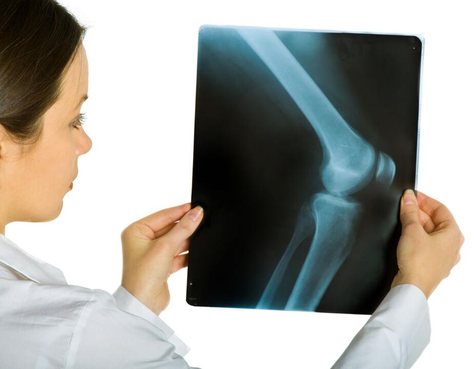 La radiographie de l'articulation du genou révélera la présence d'arthrose déformante